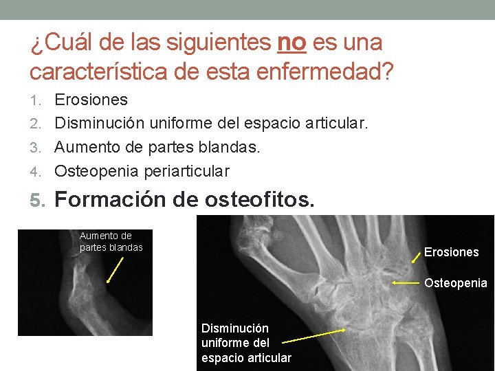 ¿Cuál de las siguientes no es una característica de esta enfermedad? 1. Erosiones 2.