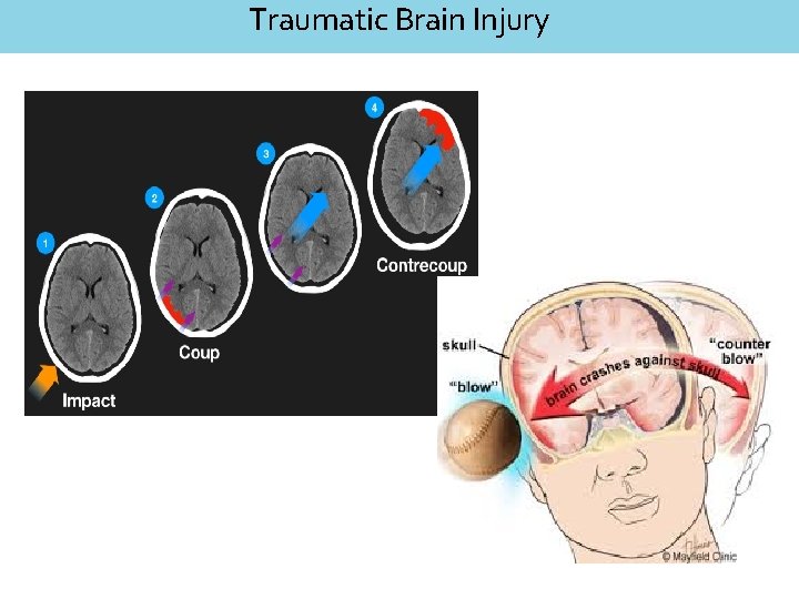 Traumatic Brain Injury 