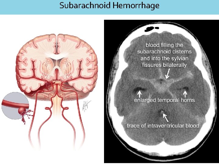 Subarachnoid Hemorrhage 