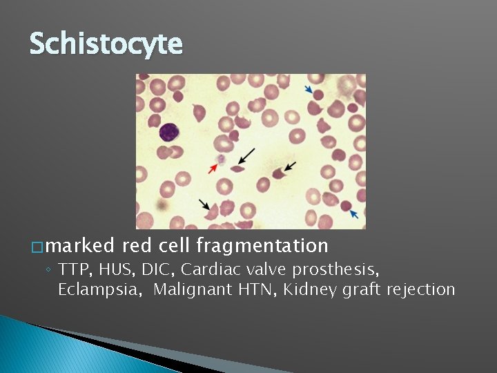 Schistocyte � marked red cell fragmentation ◦ TTP, HUS, DIC, Cardiac valve prosthesis, Eclampsia,