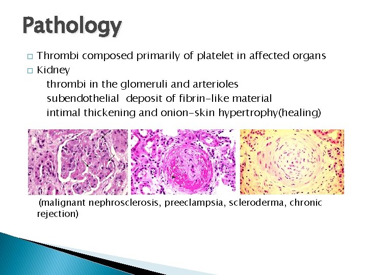 Pathology � � Thrombi composed primarily of platelet in affected organs Kidney thrombi in