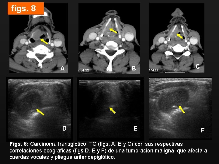 figs. 8 A B D E C F Figs. 8: Carcinoma transglótico. TC (figs.