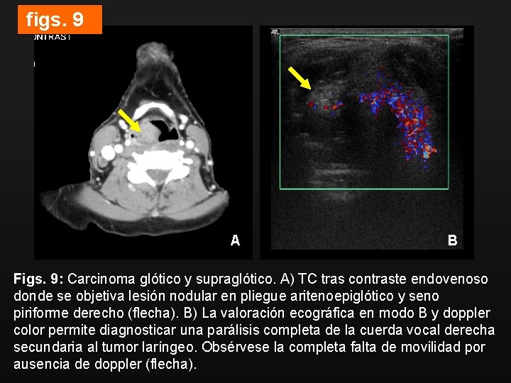 figs. 9 A B Figs. 9: Carcinoma glótico y supraglótico. A) TC tras contraste