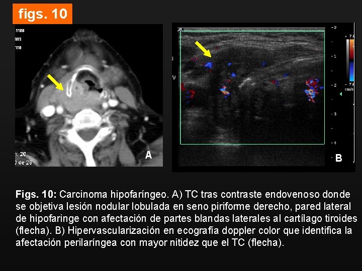 figs. 10 A B Figs. 10: Carcinoma hipofaríngeo. A) TC tras contraste endovenoso donde