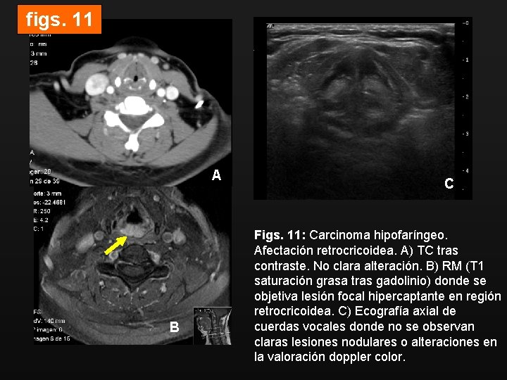 figs. 11 A B C Figs. 11: Carcinoma hipofaríngeo. Afectación retrocricoidea. A) TC tras