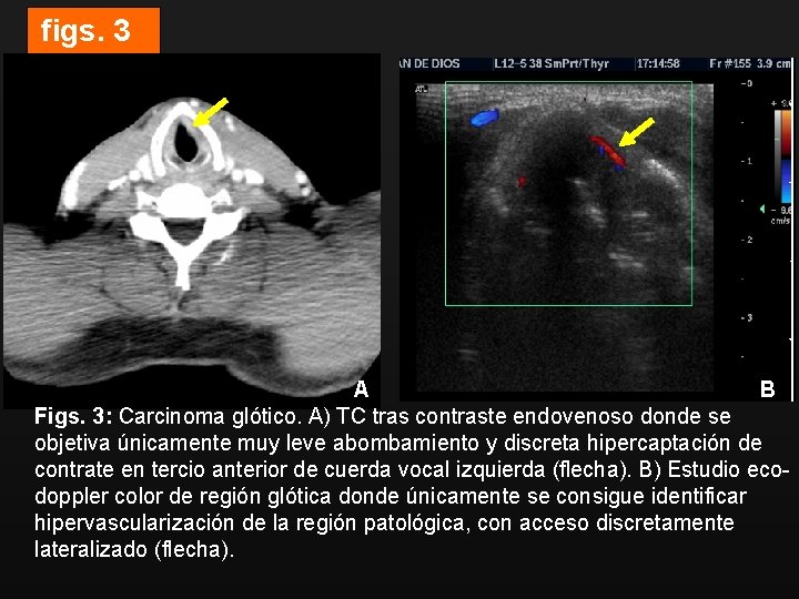 figs. 3 A B Figs. 3: Carcinoma glótico. A) TC tras contraste endovenoso donde