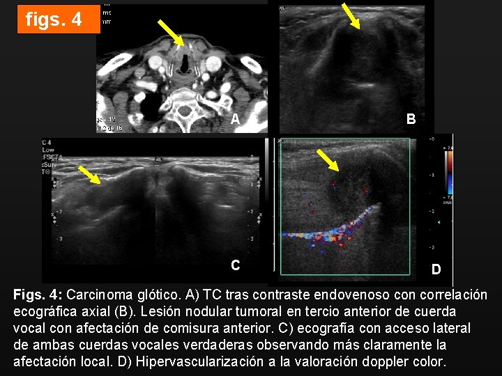 figs. 4 A C B D Figs. 4: Carcinoma glótico. A) TC tras contraste