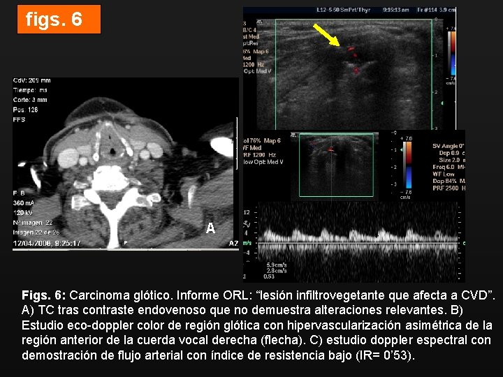 figs. 6 B A C Figs. 6: Carcinoma glótico. Informe ORL: “lesión infiltrovegetante que