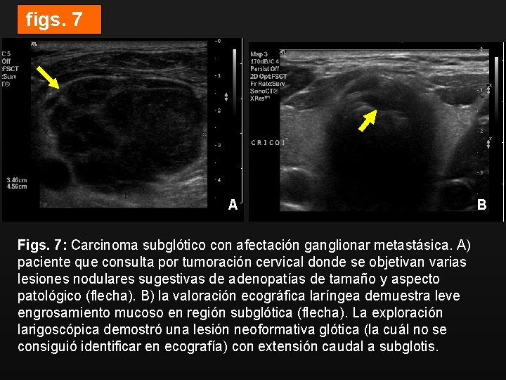 figs. 7 A Figs. 7: Carcinoma subglótico con afectación ganglionar metastásica. A) paciente que