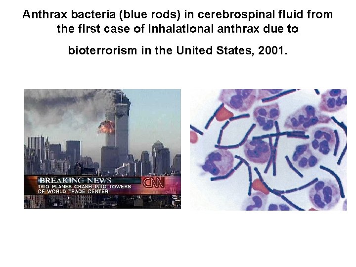 Anthrax bacteria (blue rods) in cerebrospinal fluid from the first case of inhalational anthrax