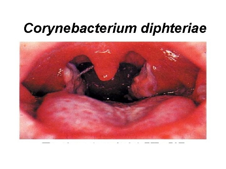 Corynebacterium diphteriae 