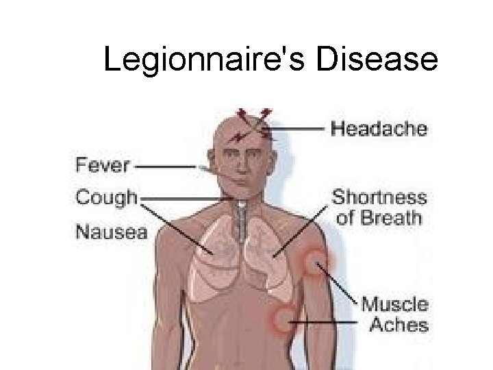 Legionnaire's Disease 