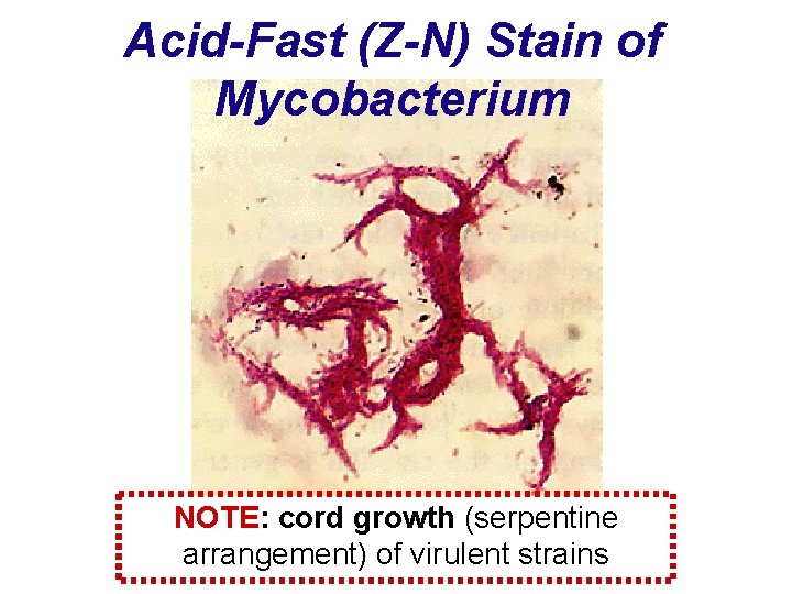 Acid-Fast (Z-N) Stain of Mycobacterium NOTE: cord growth (serpentine arrangement) of virulent strains 