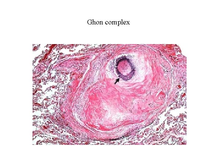 Ghon complex 