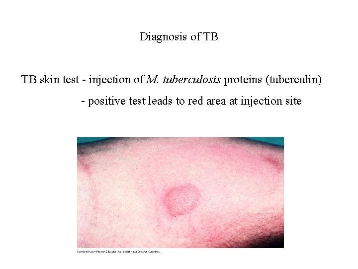 Diagnosis of TB TB skin test - injection of M. tuberculosis proteins (tuberculin) -