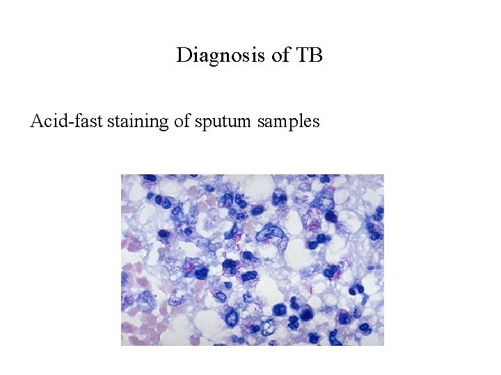 Diagnosis of TB Acid-fast staining of sputum samples 