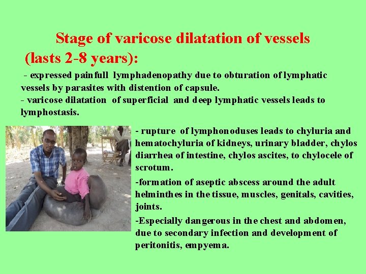 Stage of varicose dilatation of vessels (lasts 2 -8 years): - expressed painfull lymphadenopathy
