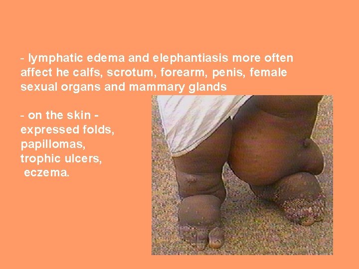 - lymphatic edema and elephantiasis more often affect he calfs, scrotum, forearm, penis, female
