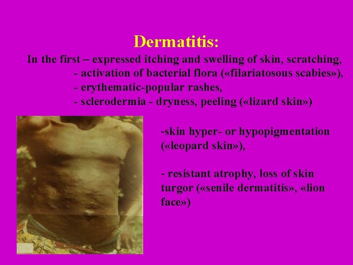 Dermatitis: In the first – expressed itching and swelling of skin, scratching, - activation