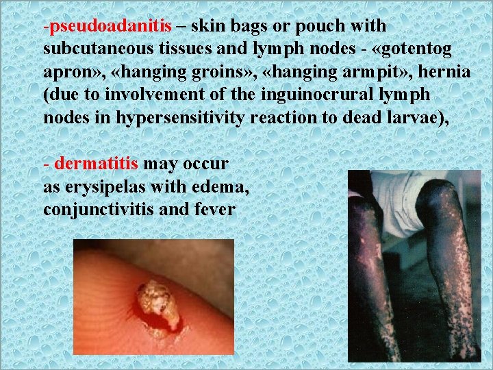 -pseudoadanitis – skin bags or pouch with subcutaneous tissues and lymph nodes - «gotentog