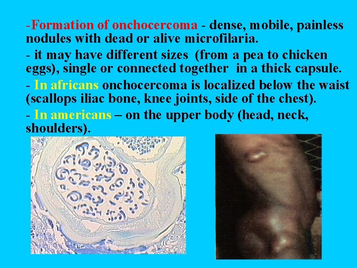 -Formation of onchocercoma - dense, mobile, painless nodules with dead or alive microfilaria. -