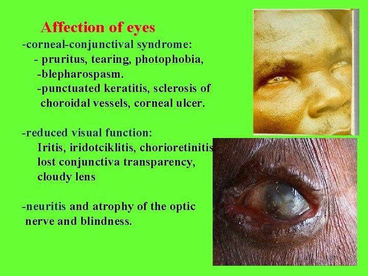 Affection of eyes -corneal-conjunctival syndrome: - pruritus, tearing, photophobia, -blepharospasm. -punctuated keratitis, sclerosis of