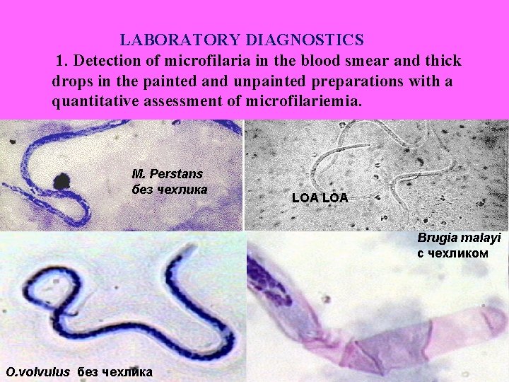 LABORATORY DIAGNOSTICS 1. Detection of microfilaria in the blood smear and thick drops in