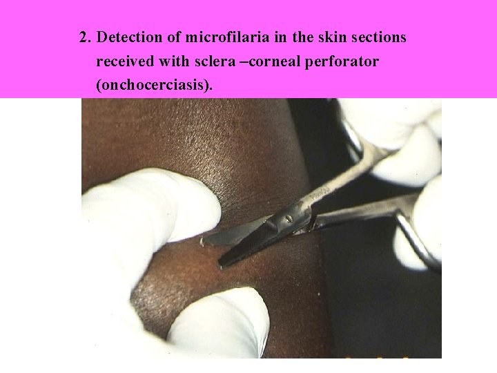 2. Detection of microfilaria in the skin sections received with sclera –corneal perforator (onchocerciasis).
