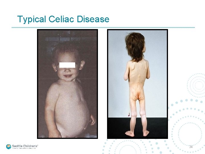 Typical Celiac Disease 34 