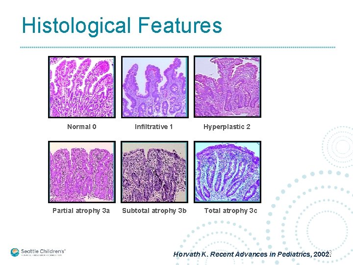 Histological Features Normal 0 Infiltrative 1 Hyperplastic 2 Partial atrophy 3 a Subtotal atrophy