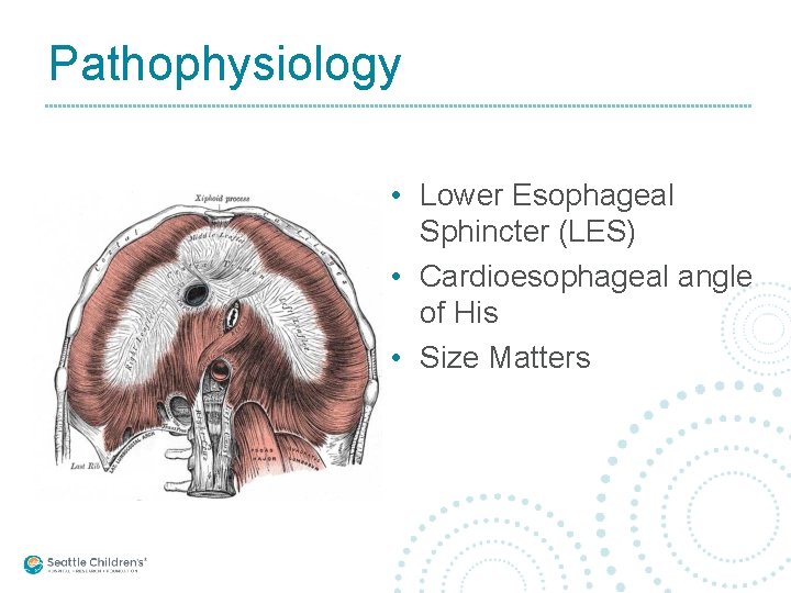 Pathophysiology • Lower Esophageal Sphincter (LES) • Cardioesophageal angle of His • Size Matters