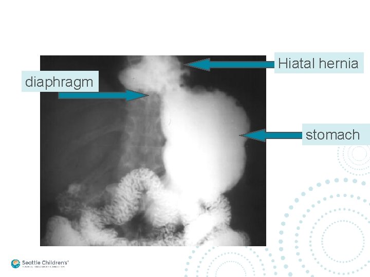 Hiatal hernia diaphragm stomach 