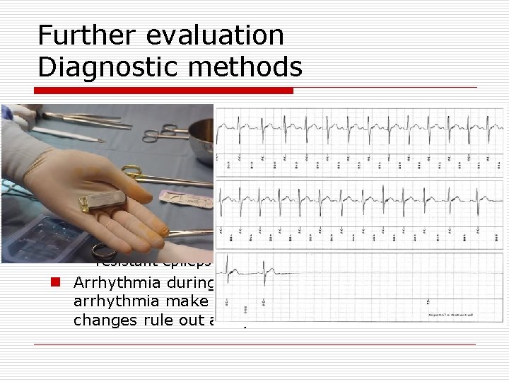 Further evaluation Diagnostic methods o ECG monitoring n In-hospital monitoring o High-risk pts. n