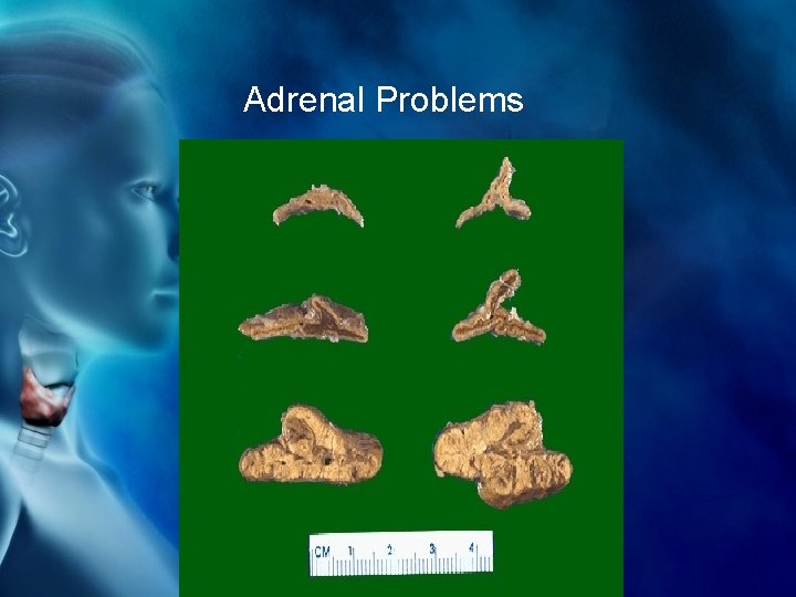 Adrenal Problems 