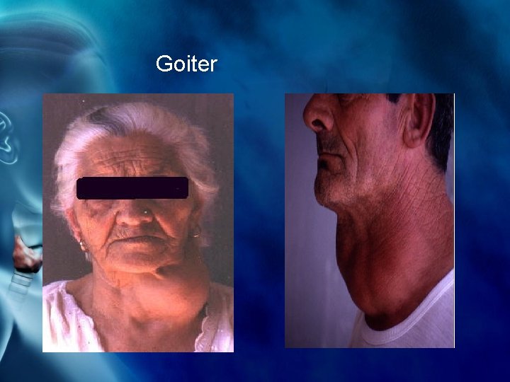 Goiter 