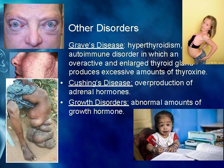 Other Disorders • Grave’s Disease: hyperthyroidism, an autoimmune disorder in which an overactive and