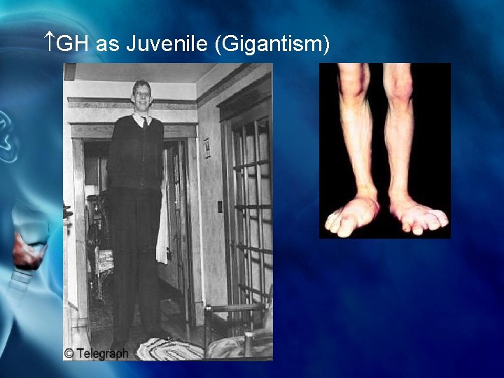  GH as Juvenile (Gigantism) 