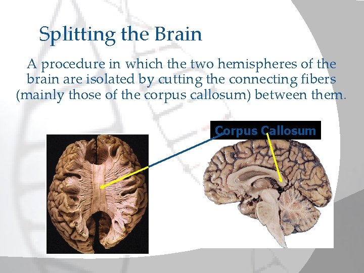 Splitting the Brain A procedure in which the two hemispheres of the brain are