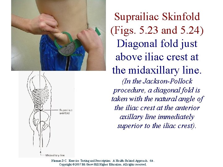 Suprailiac Skinfold (Figs. 5. 23 and 5. 24) Diagonal fold just above iliac crest
