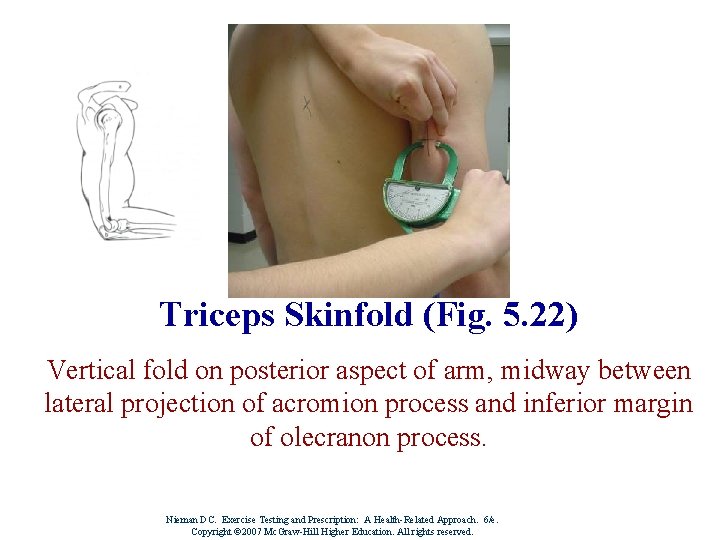 Triceps Skinfold (Fig. 5. 22) Vertical fold on posterior aspect of arm, midway between