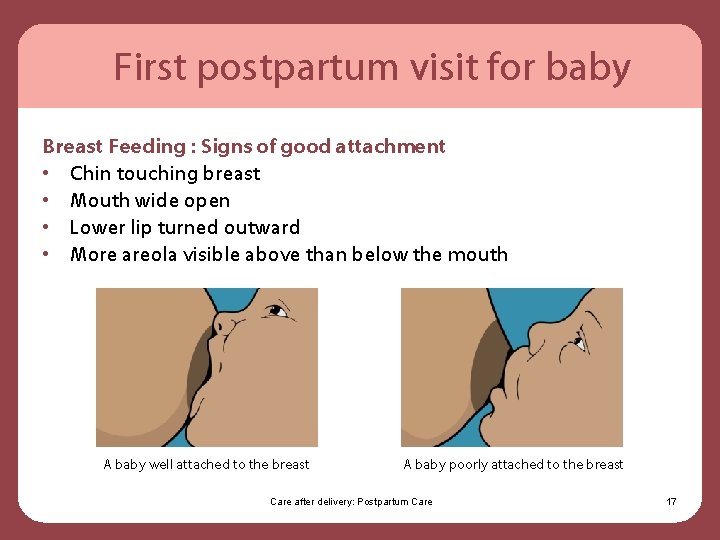 First postpartum visit for baby Breast Feeding : Signs of good attachment • Chin