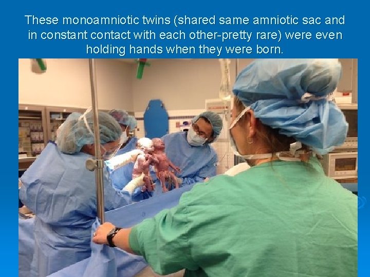These monoamniotic twins (shared same amniotic sac and in constant contact with each other-pretty