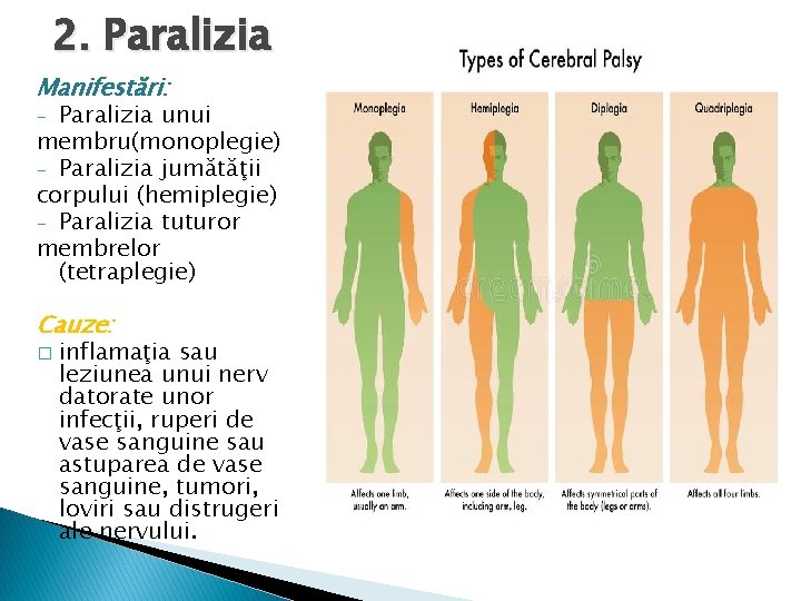 2. Paralizia Manifestări: Paralizia unui membru(monoplegie) - Paralizia jumătăţii corpului (hemiplegie) - Paralizia tuturor