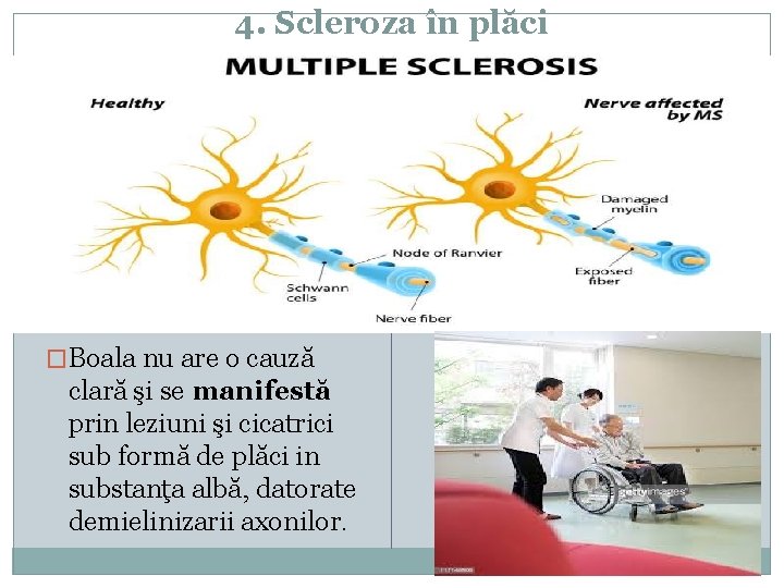 4. Scleroza în plăci �Boala nu are o cauză clară şi se manifestă prin