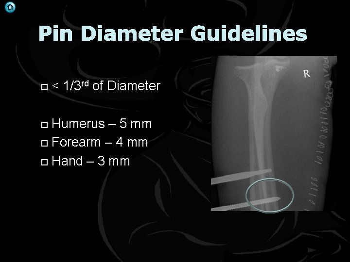 Pin Diameter Guidelines < 1/3 rd of Diameter Humerus – 5 mm Forearm –