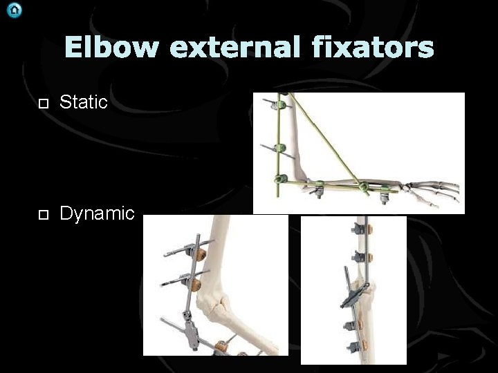 Elbow external fixators Static Dynamic 