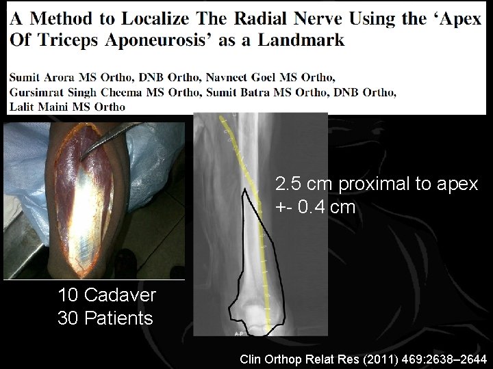 2. 5 cm proximal to apex +- 0. 4 cm 10 Cadaver 30 Patients