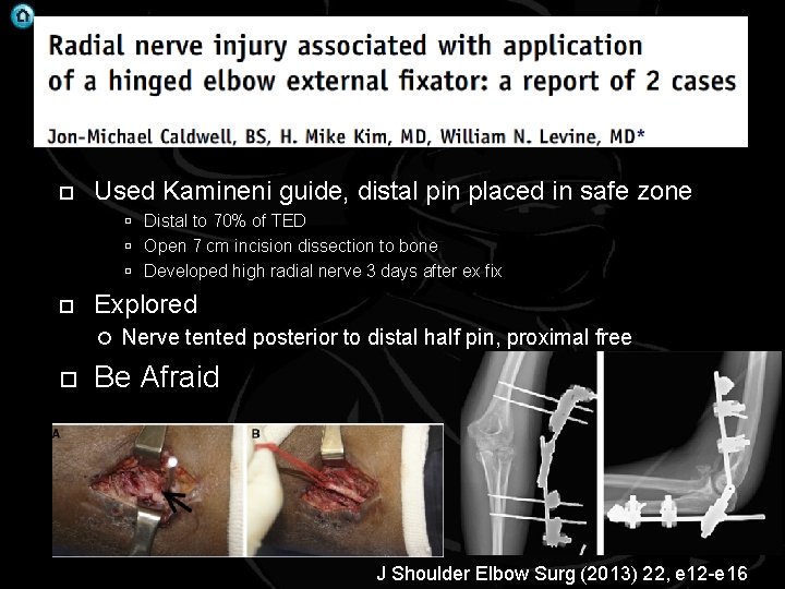  Used Kamineni guide, distal pin placed in safe zone Distal to 70% of