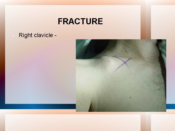 FRACTURE Right clavicle - 