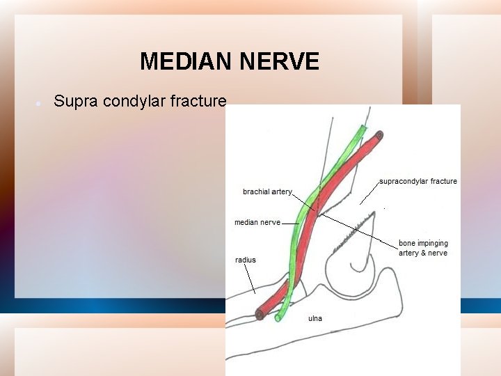 MEDIAN NERVE Supra condylar fracture 